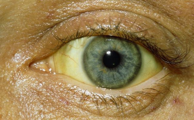 黄疸性肝炎眼睛图片