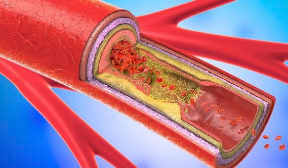 血管通畅的人身上会有5个表现能占3个以上的血管不会堵
