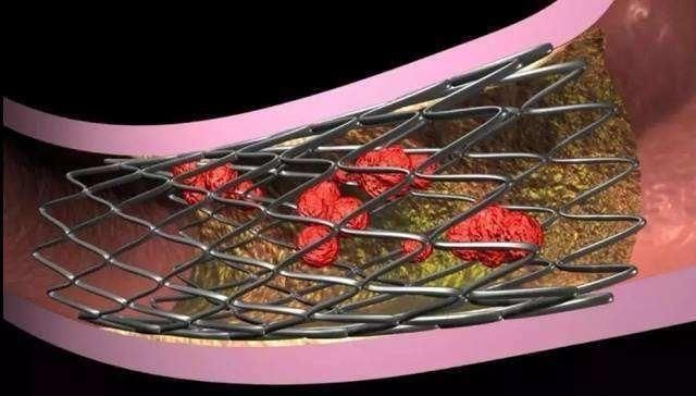 冠心病支架的7个风险!医生通通告诉你!值得收藏