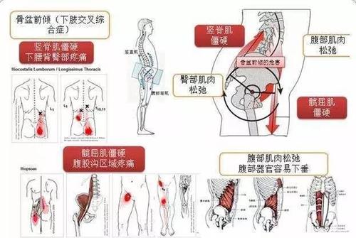 骨盆前倾危害有多大一不留神你就会忽略