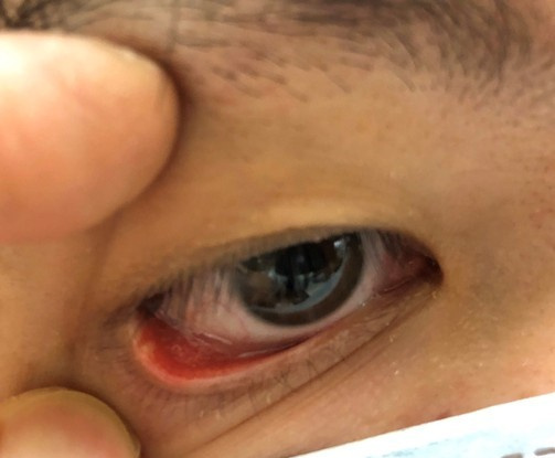 长针眼该热敷还是冰敷?医生教你解除危机,4种人最容易上眼