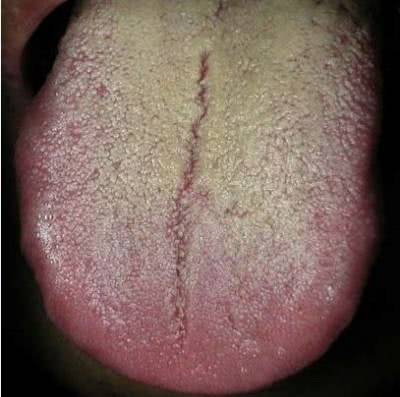 医生们发现:转氨酶升高后,舌头上会有一些"奇怪"的症状|肝细胞|蒲公英