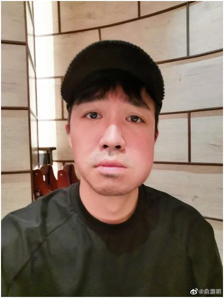 俞灏明脸部肿胀太痛苦,在线求助网友意见,死里逃生后颜值成硬伤