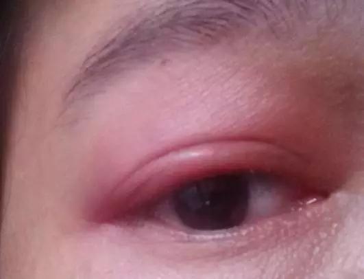 皮肤上这3种东西,是螨虫在"做窝"了!这3个方法除螨最快!