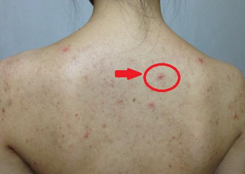 皮肤上这3种东西,是螨虫在"做窝"了!这3个方法除螨最快!