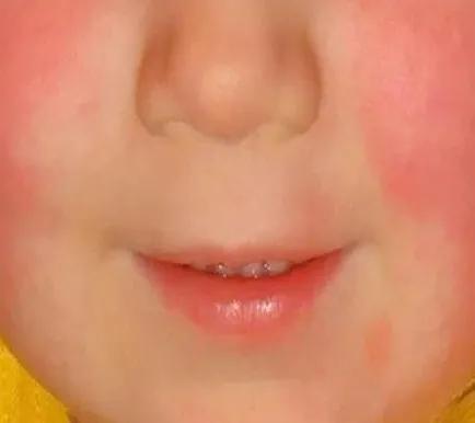 宝宝出现"草莓舌",警惕猩红热