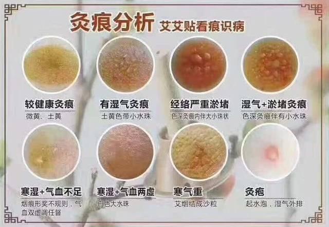 灸疮若发,去病似把抓!别把烫伤和灸花混为一谈!