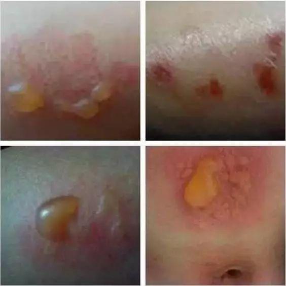 灸疮若发,去病似把抓!别把烫伤和灸花混为一谈!