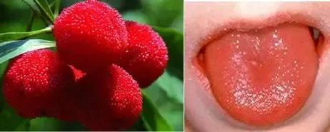 宝宝出现"草莓舌",警惕猩红热