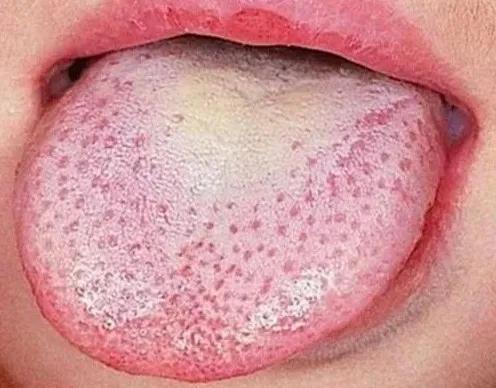 宝宝出现"草莓舌",警惕猩红热