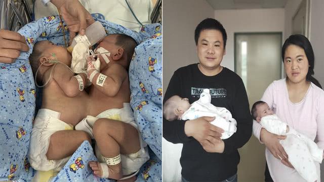 喜讯！山东连体女婴经7小时手术顺利分离 父母：感谢千万网友