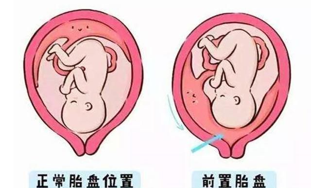 正常的胎盘位置图片