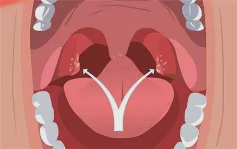 出现这个症状需高度警惕!|扁桃体炎|扁桃体|恶性肿瘤_新浪新闻