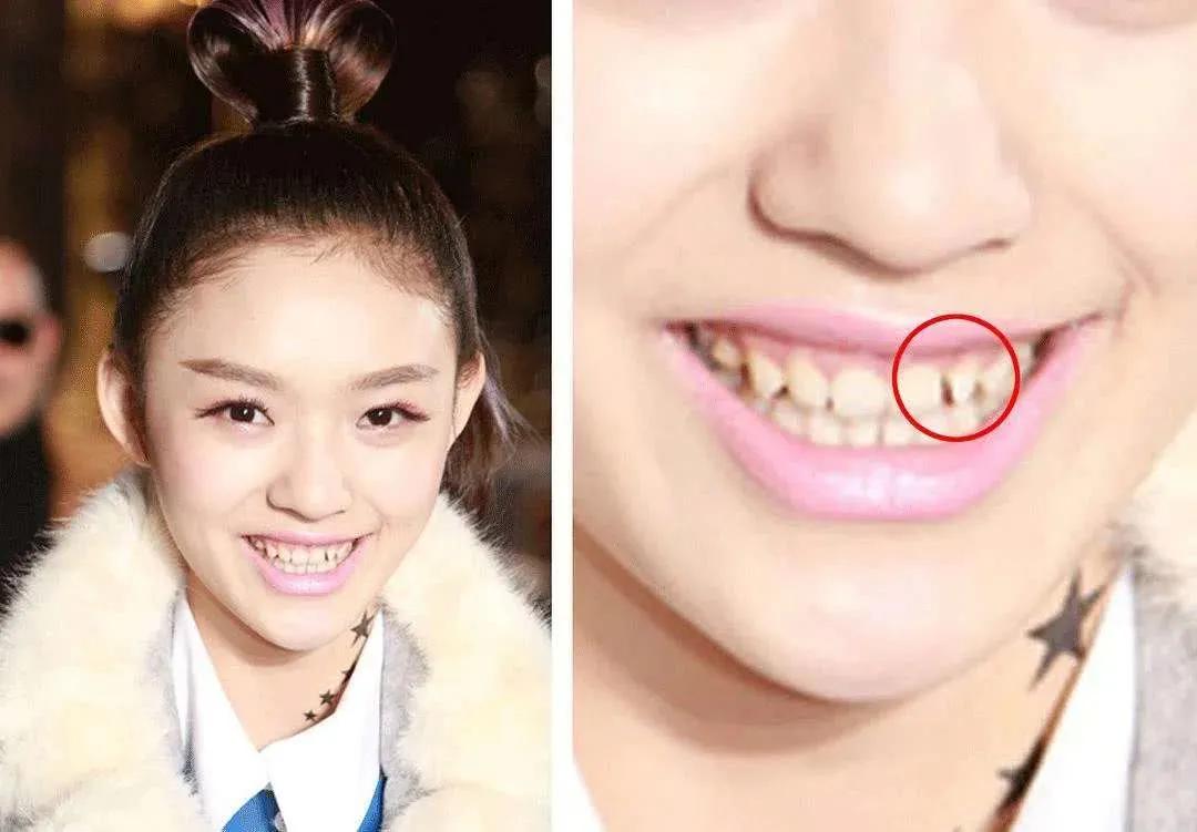 《极挑》热巴脸垮严重,与3年前《跑男》差太多,她不该做烤瓷牙