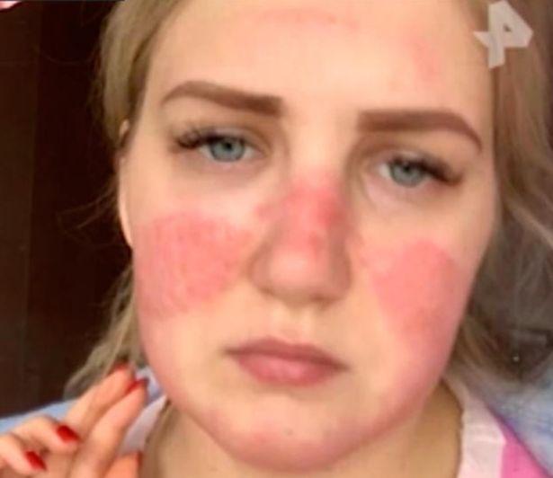 口罩重复戴,俄罗斯美女护士面部出现严重过敏,院方不想承担责任