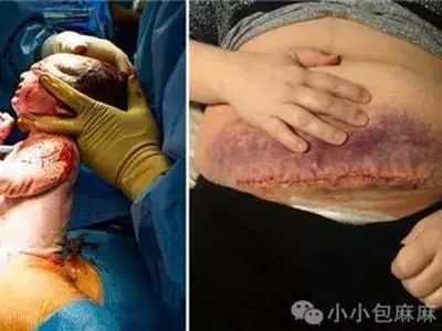 还有,不要以为产妇打了麻药就什么都不知道.