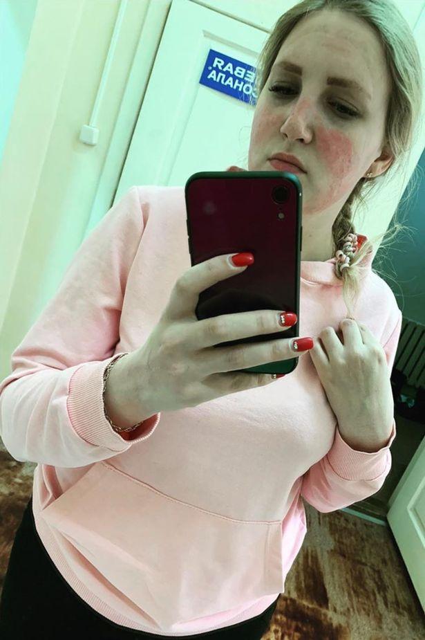 口罩重复戴,俄罗斯美女护士面部出现严重过敏,院方不想承担责任