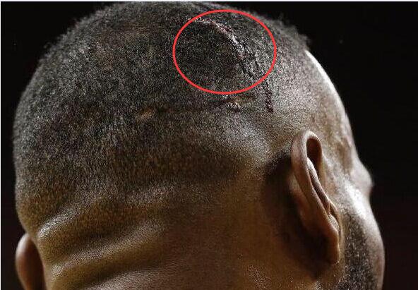 成功不易,全靠拼命!看nba众球星伤疤,你还羡慕他们工资高吗?