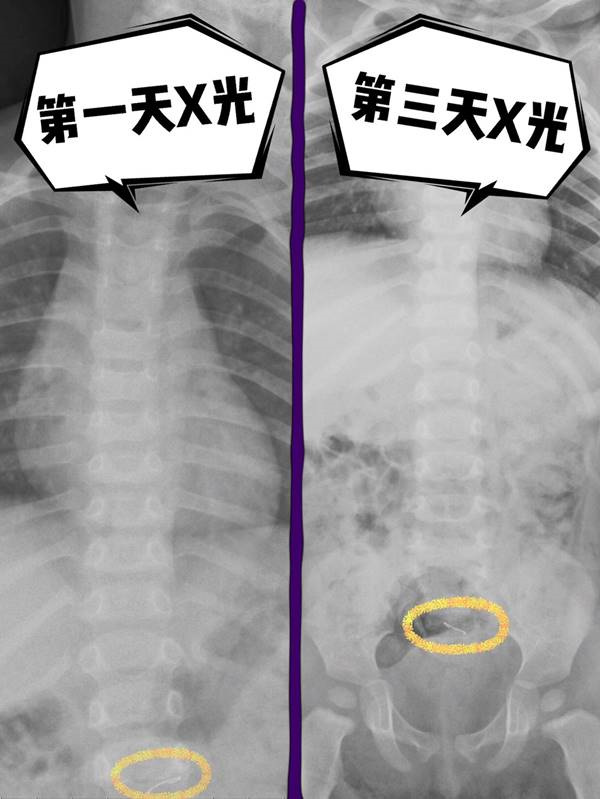 1岁男孩误吞钉书针险肠穿孔!3大误食状况把握黄金急救时间