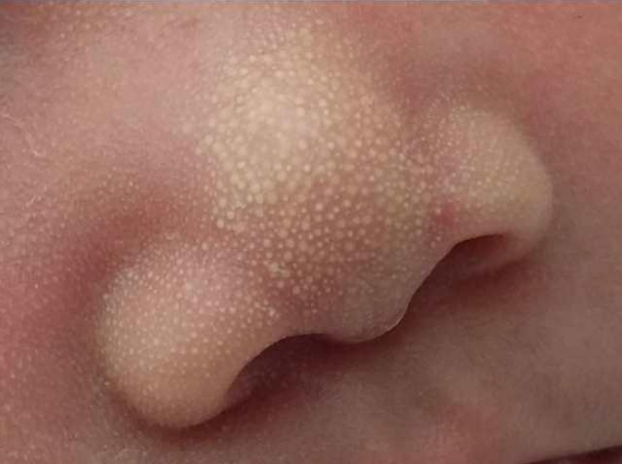 初生婴儿鼻子上怎么有很多小白点,如何解决|粟粒|宝宝|鼻子_新浪新闻