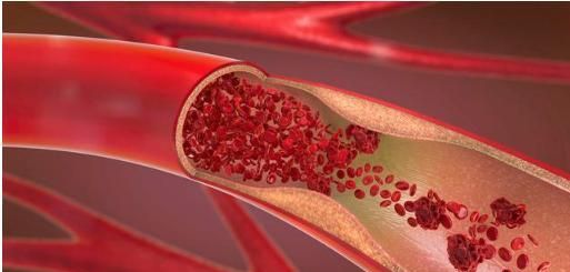 研究显示,我们从儿童期就开始动脉硬化,这样才能预防心血管病