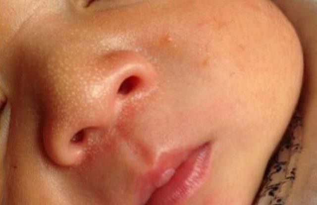 刚出生宝宝鼻子上就长脂肪粒?小白点到底是什么