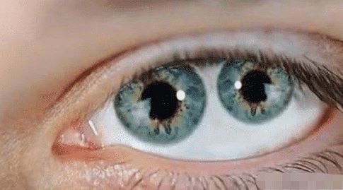 拥有“双瞳孔”的人，他们看到的世界，和正常人有什么不同？|瞳孔|正常人|视力|独特性|变异_新浪新闻