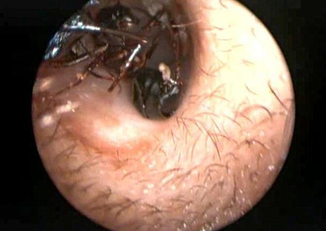 女孩发现耳朵痒痒的,看到医生从耳朵掏出的东西,让所有人看呆!