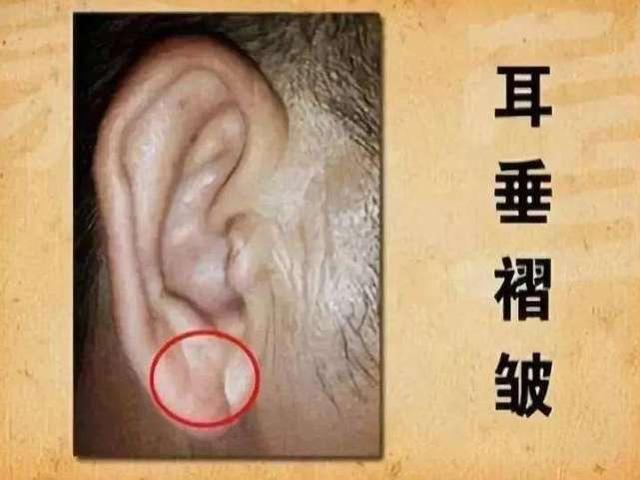 身体出现"2痛,2褶,2红",可能是血栓警报,一发现最好去检查