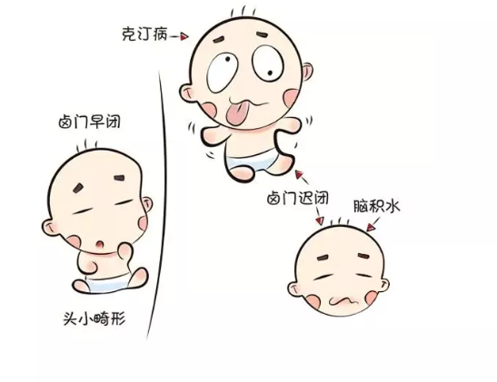 克汀病是一种呆小症,多发生于甲状腺肿流行地区,在妊娠第10周-12周