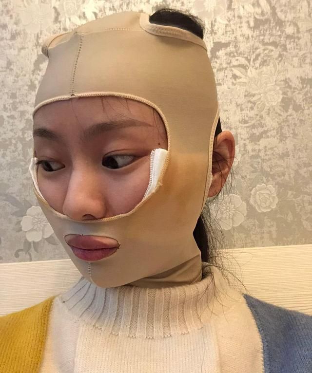 女子花5万"换头",前后对比犹如换了个人,只因做了这个手术