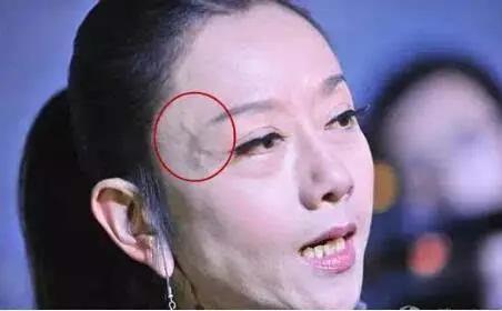 青筋的分布代表不同疾病看艾灸怎样调理这三大瘀滞