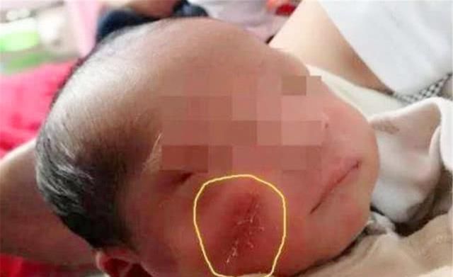 曾因吃奶太用力,被妈妈用剪刀"划花脸",5年后他的现状咋样?