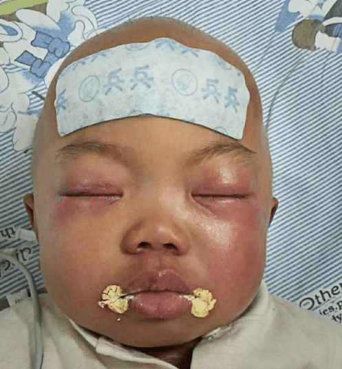 两个月后,基因检测结果出来了,小煜棋被确诊为黏多糖贮积症Ⅵ,而且更