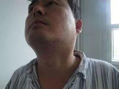 男子不痛不痒,查出肺癌,提醒:身体出现"2凸3黑",及时查查肺|新冠肺炎_