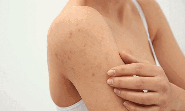 鸡皮肤可以敷泥膜吗(鸡皮肤可以用搓泥宝吗) 鸡皮肤可以敷泥膜吗(鸡皮肤可以用搓泥宝吗)