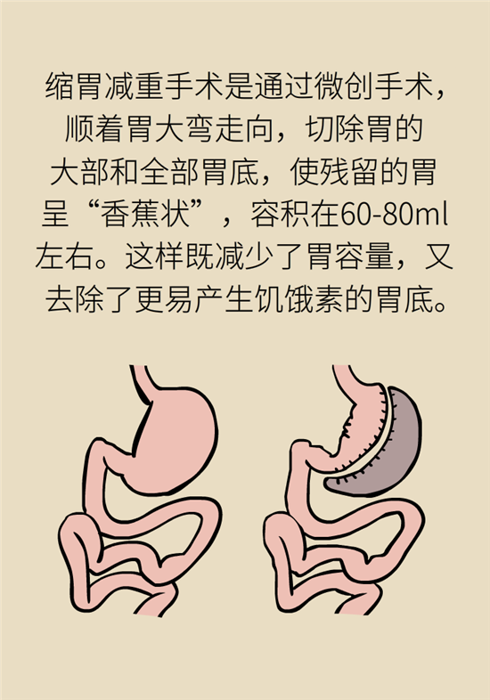 缩胃减重手术,真的有那么神奇吗?