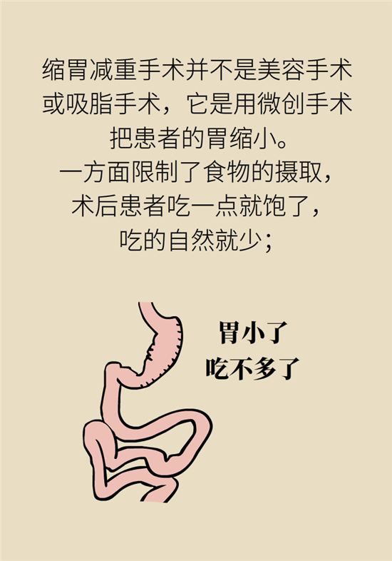 缩胃减重手术,真的有那么神奇吗?