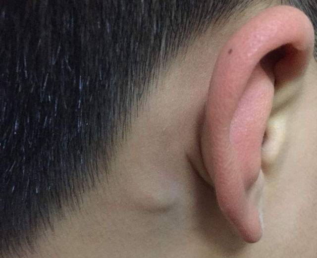 为什么说耳朵下面长小疙瘩的人有福气究竟什么说法是真的吗