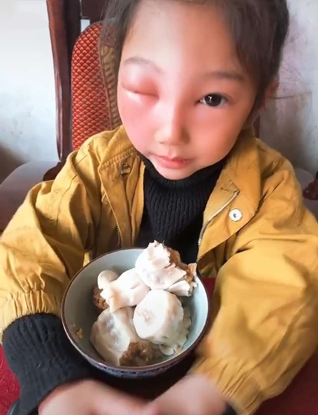 女儿捅马蜂窝脸被蜇睁一只眼闭一只眼模样太萌,网友:童年完整