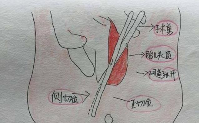 撕裂和侧切哪个更可怕?为了避免这些情况,孕期应该这样做