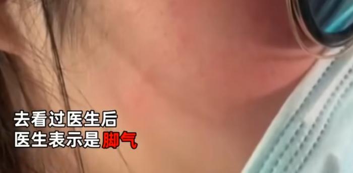 女子脸部莫名红点检查竟是脚气,回想后女子一脸尴尬!