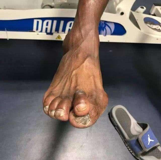詹姆斯穿世界最好的鞋脚趾依旧变形