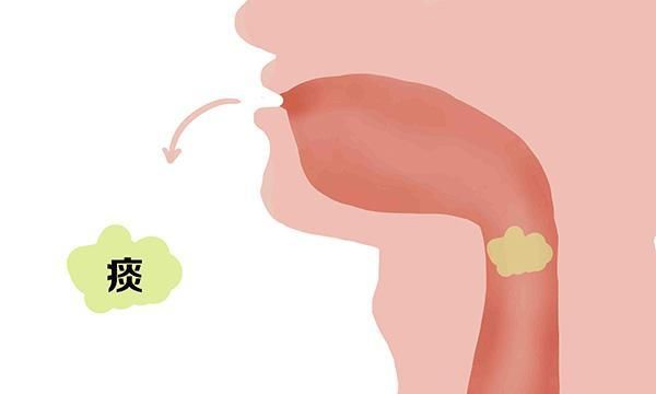 咳出白痰、黄痰、黑痰，分别是什么情况？哪种情况比较严重？