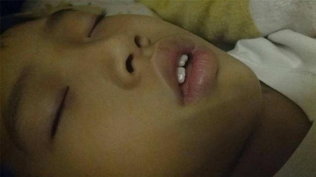 女儿爱"张嘴"睡觉,被亲妈用胶布"封嘴",医生却直夸:做得好|小姨|胶布