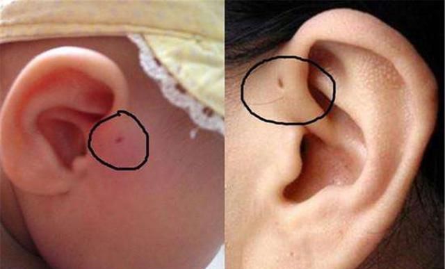 为什么有的孩子耳朵有"小孔"?医生大多不会说
