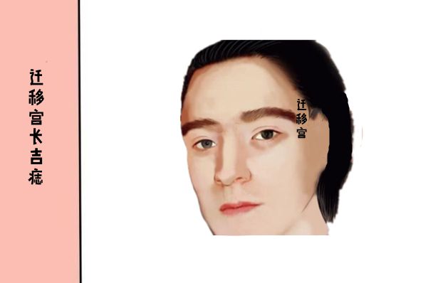 迁移宫长吉痣