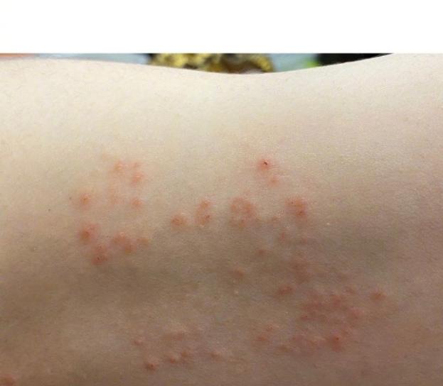 孕妇不易,刘璇二胎孕期满手臂红疹子奇痒难忍,网友劝其尽早就诊