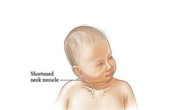 五个月婴儿歪脖子图片图片