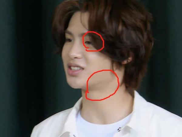 黄明昊上跑男脸部浮肿眼睛难睁开双下巴明显,仅18岁被疑多处整容